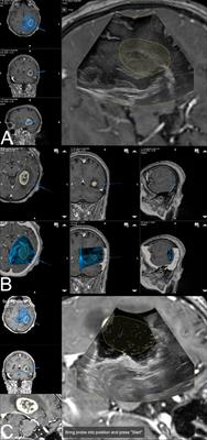 Navigated Intraoperative 3D Ultrasound in Glioblastoma Surgery: Analysis of Imaging Features and Impact on Extent of Resection